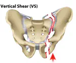 Modeling Vertical Shear Fracture in Human Sacrum