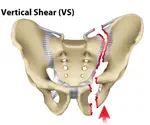 Modeling Vertical Shear Fracture in Human Sacrum
